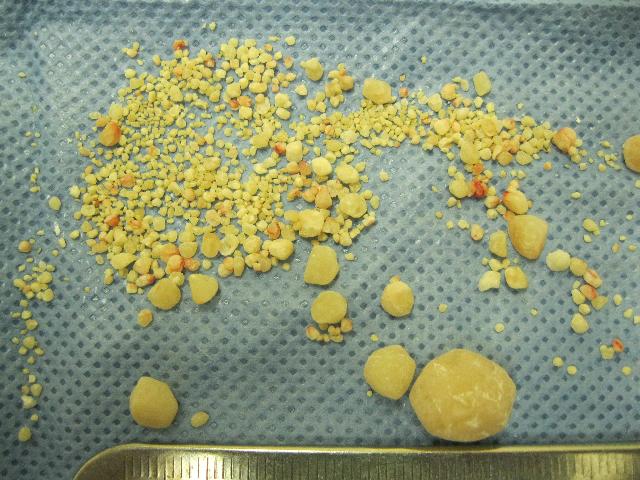 Bladder Stones