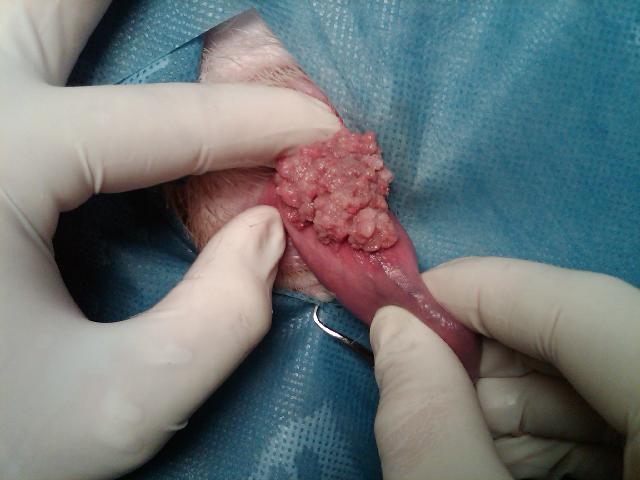 Penile Tumor